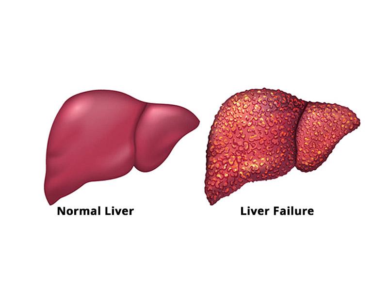 Acute Liver Failure Market Projected to Reach USD 4.3 Billion by 2034