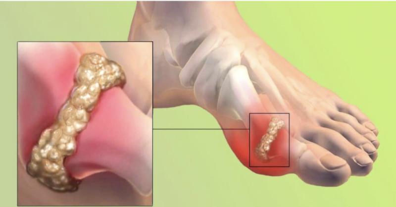 Global Gout Therapeutics Market Set for Strong Growth Driven by Rising Prevalence & Innovative Treatments 2025 | DataM Intelligence