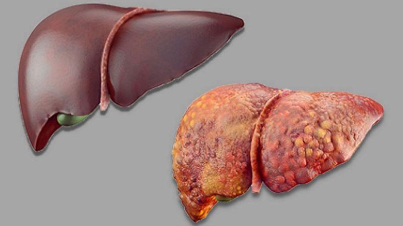 Liver Failure Market Anticipated to Hit USD 14.5 Billion by 2034