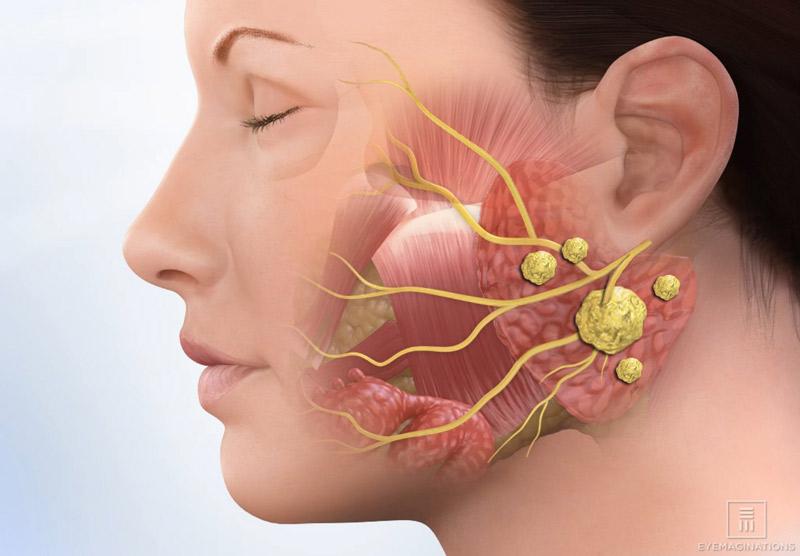 Salivary Gland Infection Market Set to Grow to USD 2.1 Billion by 2034