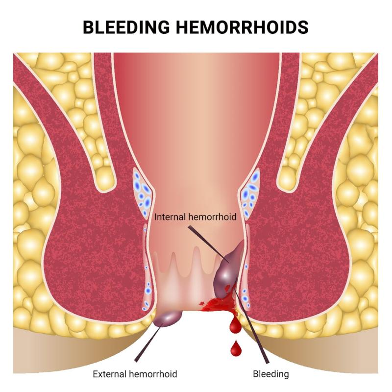 Hemorrhoids Market Projected to Reach USD 3.7 Billion by 2034