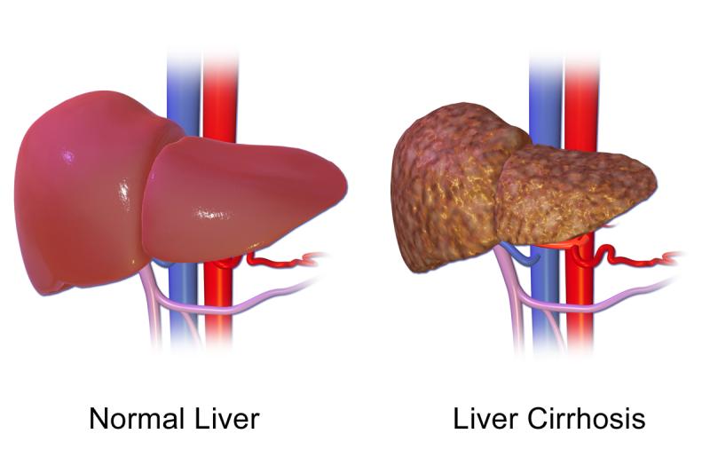 Chronic Liver Disease Market to Reach USD 23.8 Billion by 2034