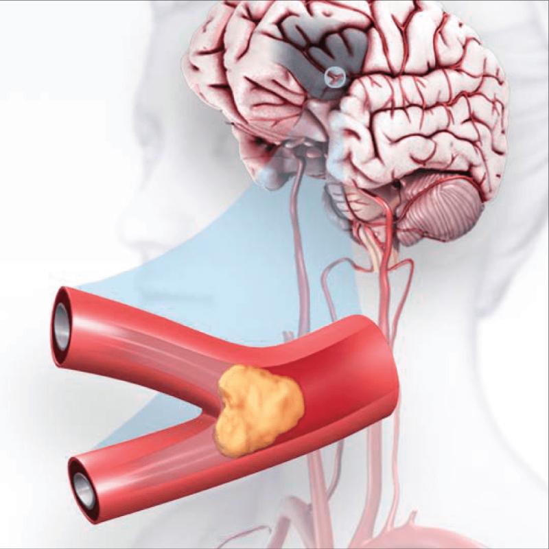 Market statistics for drugs against acute cerebral ischemic stroke