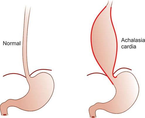 Esophageal Achalasia Market to Reach USD 720 Million by 2034