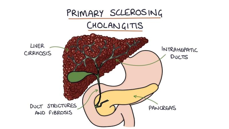 Primary Sclerosing Cholangitis Market to Reach USD 2.5 Billion by 2034