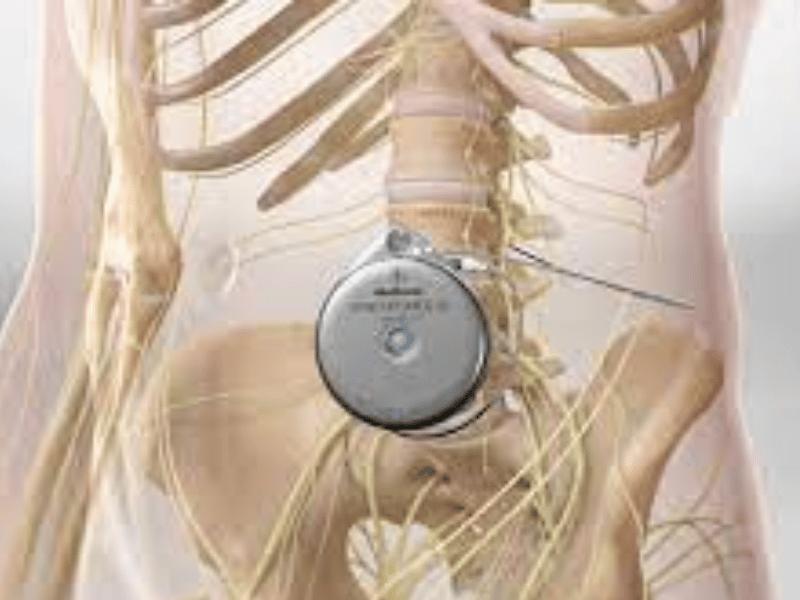 Intrathecal Pumps Market Size Analysis, Competitive Insights, Leading Players and Growth Opportunities by 2033
