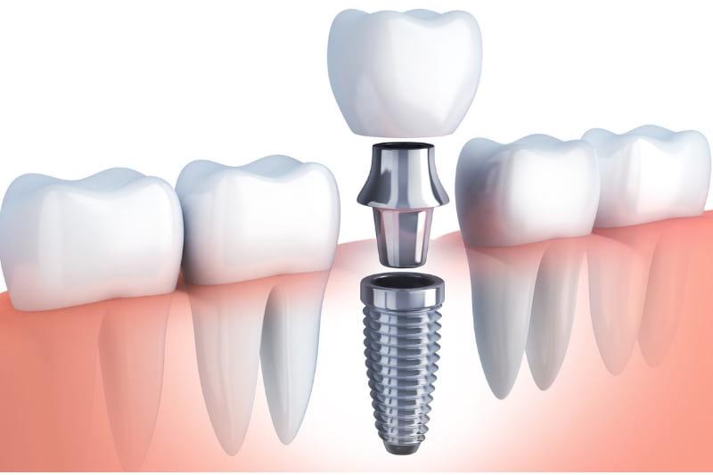 Dental Implants Market Set to Witness Significant Growth by 2033 | Nobel Biocare Services AG, Osstem Implant, BioHorizons, MIS Implants Technologies
