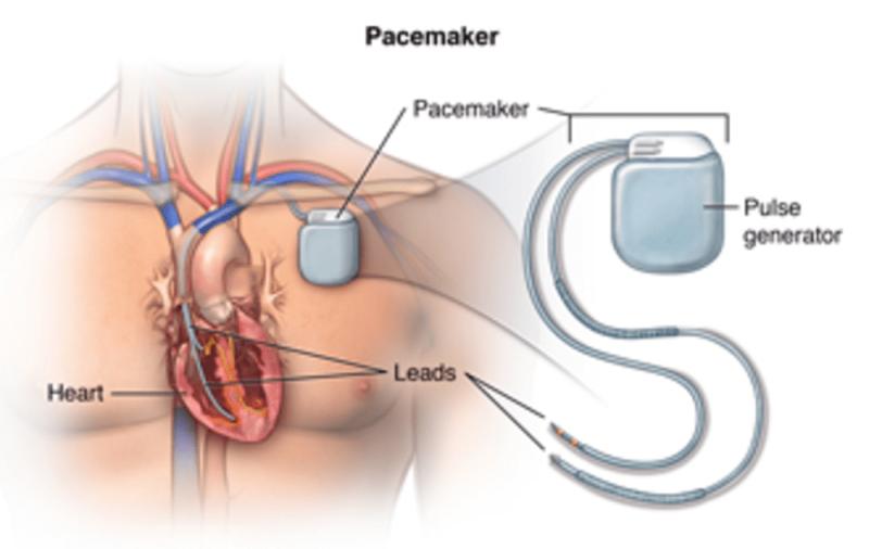 Implantable Cardiac Pacemaker Treatment Market Booming