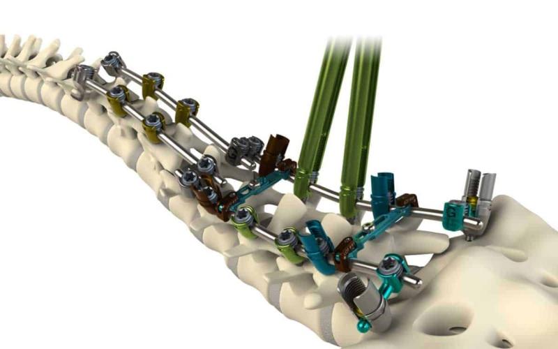 Thoracolumbar Spine Devices Market Report Analysis, Research