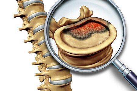 BONE Cancer Diagnosis Market Report Analysis, Research Studies