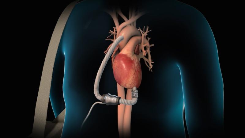 Ventricular Assist Devices Industry is Expected to Reach Huge