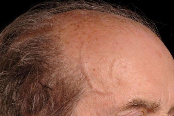 Giant Cell Arteritis Market is expected to reach USD 3 billion by 2034