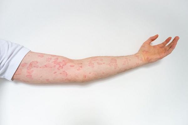 Chronic Inducible Urticaria (CIndU) Market Growth, Applications, Innovations and Business Outlook by 2034