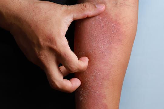 Moderate to Severe Atopic Dermatitis Market is expected to reach USD 15.4 billion by 2034