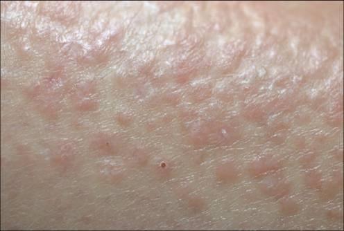 Chronic Pruritus Market New Product Development & Latest Trends