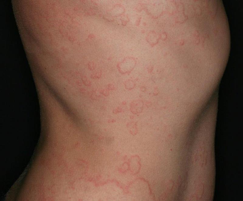 Chronic Spontaneous Urticaria Market is expected to reach USD 2.1 billion by 2034