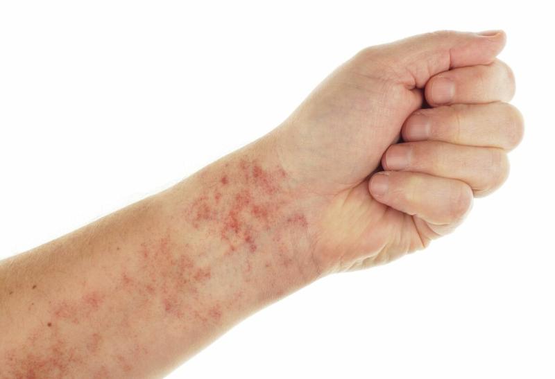 Immune Thrombocytopenia Market is expected to double by 2034, reaching USD 4.9 billion