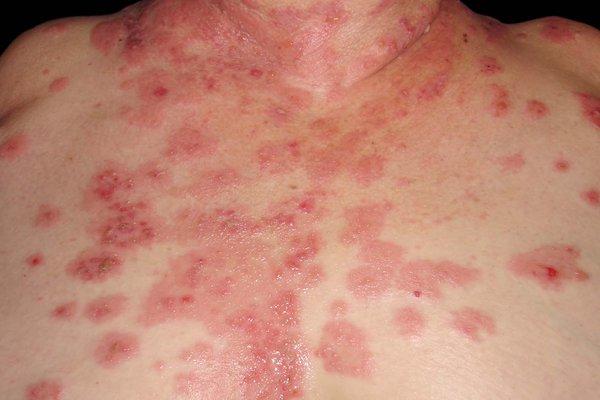 Bullous Pemphigoid Market to Set Phenomenal Growth From 2025 to 2034