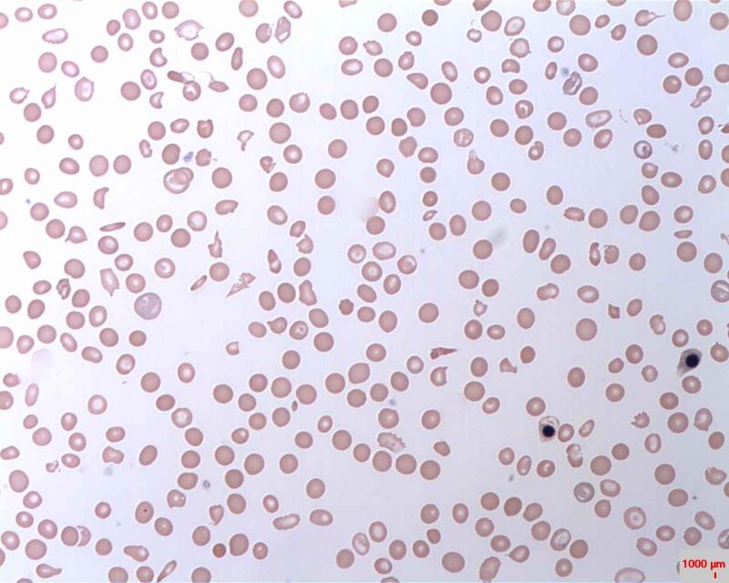 Paroxysmal Nocturnal Hemoglobinuria (PNH) market is expected to reach USD 11.6 billion by 2034