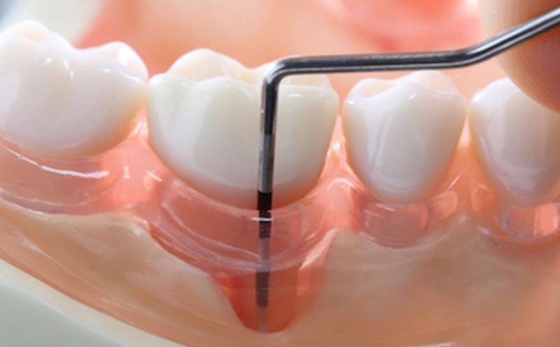 Periodontal therapeutics market doubles to $1.95 Billion by 2033, driven by oral health awareness & advanced therapies.