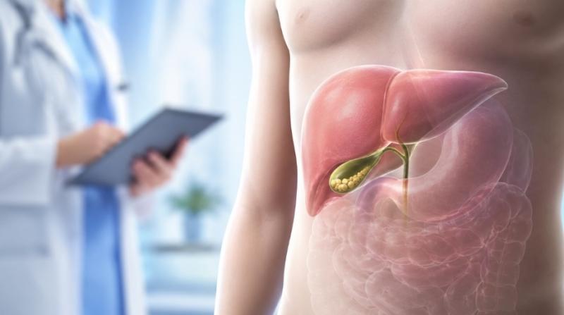 Cholecystectomy and Gallstones: When Surgical Treatment