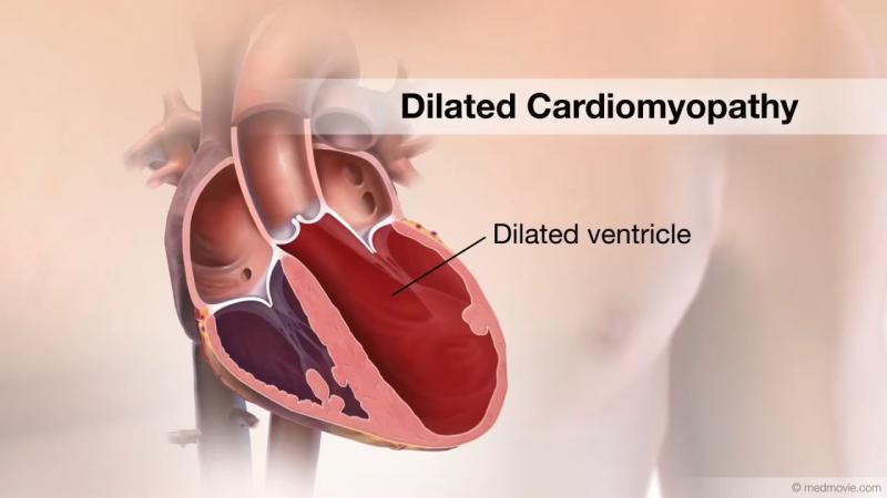 Global Dilated Cardiomyopathy Therapeutics Market Set for Robust Growth with Breakthrough Treatments & Expanding Patient Care Strategies 2025 | DataM Intelligence