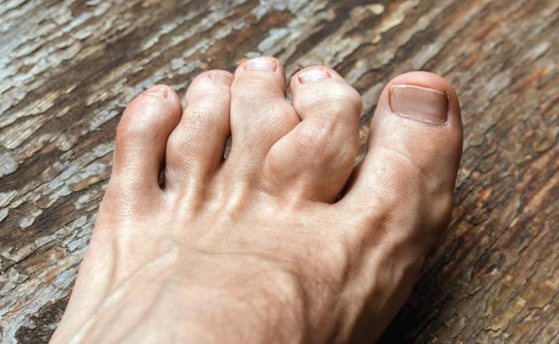 Chronic Refractory Gout Market is expected to reach USD 9.1 billion by 2034