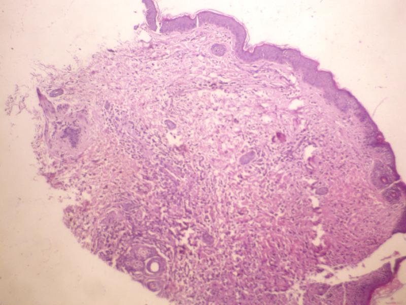 Targeted Therapies Drive Growth in Langerhans Cell Histiocytosis Management Market to 2031
