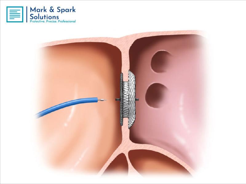 Global Patent Foramen Ovale Closure Device Market Poised for Robust Growth, Forecast to Reach USD 433.56 Million by 2030