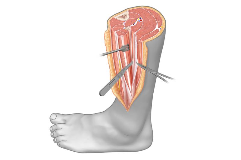 Fasciotomy Market Overview 2025: Trends in Wound Closure & Regenerative Therapies |Top Players are Zipline Medical Inc., Stryker Corporation, DermaClose.