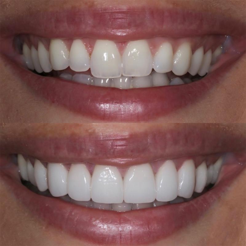 Dental Contouring