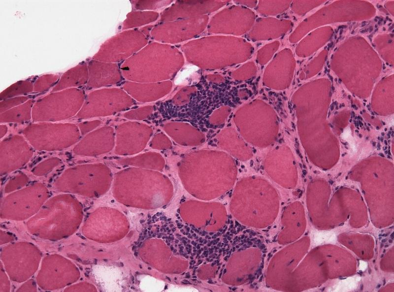 Global Polymyositis Drugs Market Growth Driven by Rare Disease Research and Pipeline Therapies