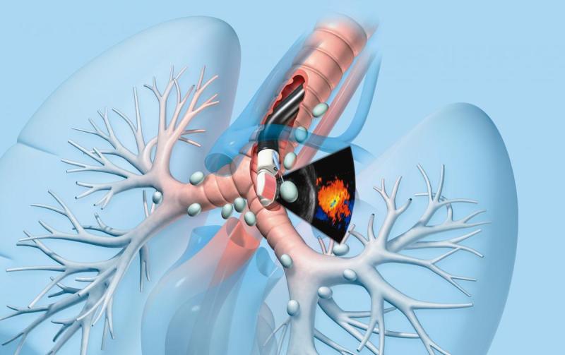 Endobronchial Ultrasound Biopsy Market Set for Rapid Growth: Cutting-Edge Diagnostics Driving Global Demand 2025 | Top key players - Olympus Corporation, Medtronic, CLINODEVICE.
