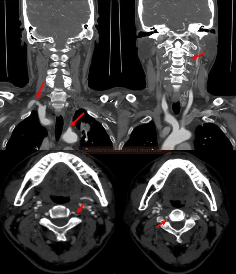 Carotid Stenotic Scan Devices Market: Innovation in Stroke Prevention Diagnostics | Exclusive Market Analysis 2025
