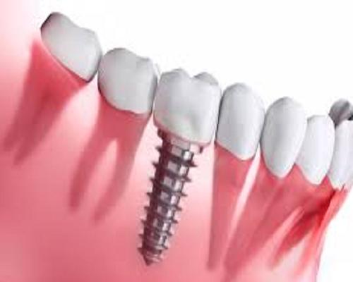 Dental Implants Market