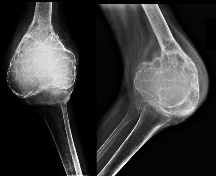 Chondrosarcoma Market Driven by Rare Cancer Research, Targeted Therapies, and Orphan Drug Incentives | Top Companies are Pfizer Inc., Eli Lily and Company, Gatewell Oncology