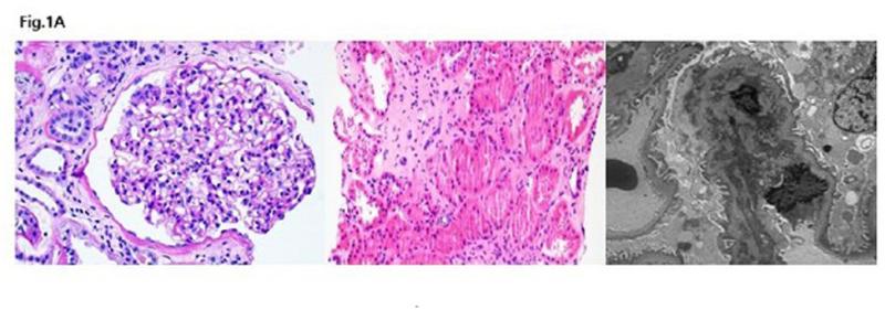 Alport Syndrome Market is Expected to Reach $4.5 Billion by 2034