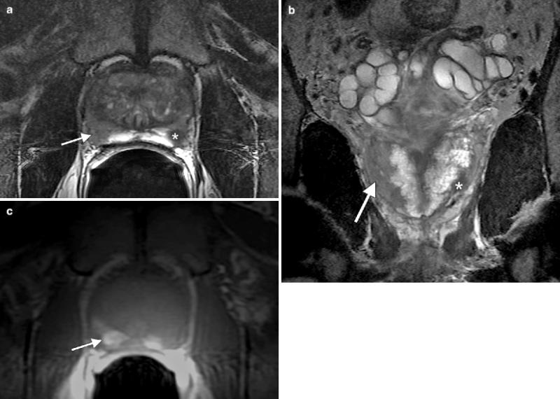 Prostate Cancer Imaging Market Poised for Breakthrough Growth with Next-Gen Diagnostic Technologies 2025 | Top key players - GE Healthcare, Siemens Healthineers, Philips.