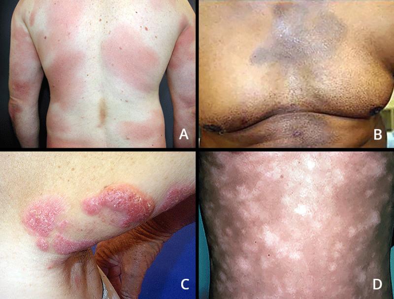 Cutaneous T-Cell Lymphoma Marketis expected to reach USD 2.3 billion by 2034