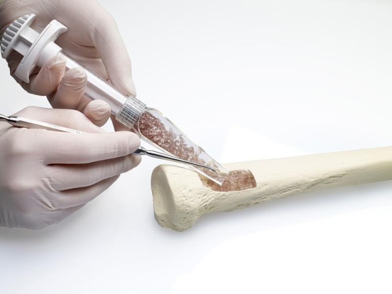 Bone Grafts and Substitutes Market Set to Redefine Orthopedic Solutions with Accelerated Growth Trends 2025 | Top key players - Orthofix Medical Inc., DePuy Synthes, Integra LifeSciences.