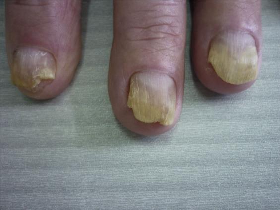 Onychomycosis Market is expected to reach USD 8.4 billion by 2034