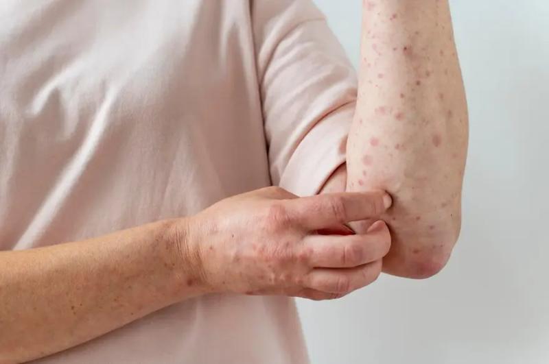 United States Valley Fever Market Set for Strong Growth as Rising Awareness and Advanced Diagnostics Drive Demand 2025 | Top key players - Pfizer, Merck, Astellas Pharma