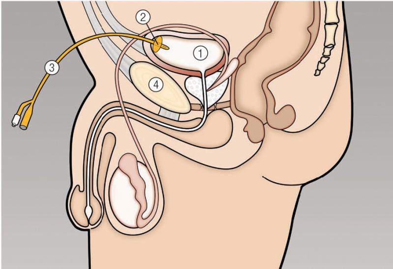 Suprapubic Catheter Market Set to Witness Significant Growth by 2032 | Teleflex Incorporated, Coloplast Group, B. Braun Melsungen AG