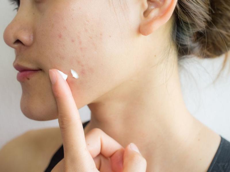 Anti-acne Cosmetics Market : Opportunities for Investment and Mergers & Acquisitions