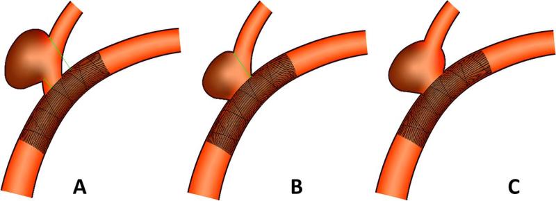 Flow Diverters Market is expected to reach USD 3.5 billion by 2034