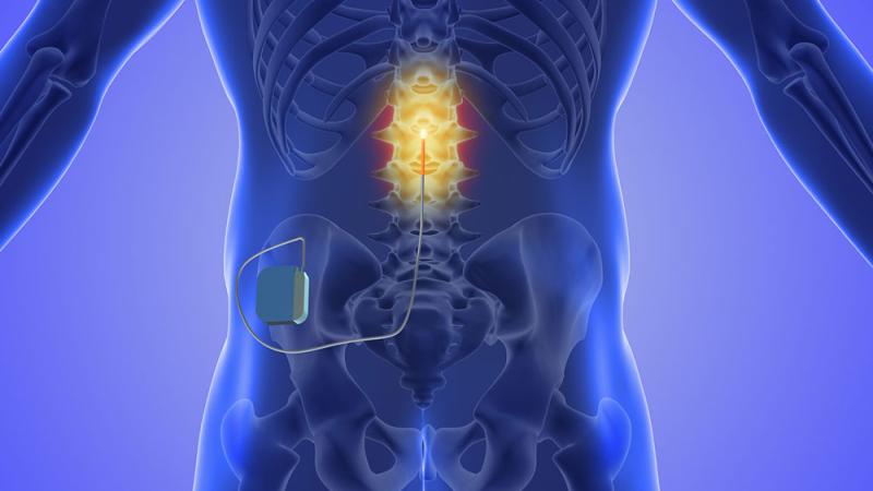 Neuromodulation