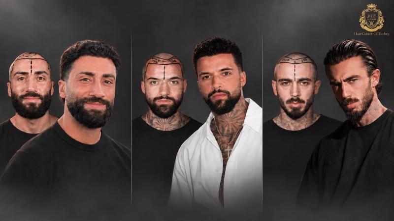 Hair Transplant in Turkey: Hair Center of Turkey Outlines Its