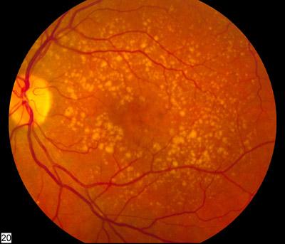 Intermediate Age-Related Macular Degeneration (AMD) Market is expected to reach USD 350 billion by 2034