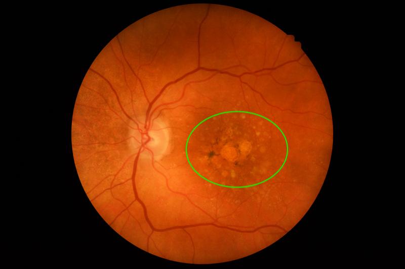 Age-Related Macular Degeneration (AMD) Market is expected to reach $15.7 billion by 2034