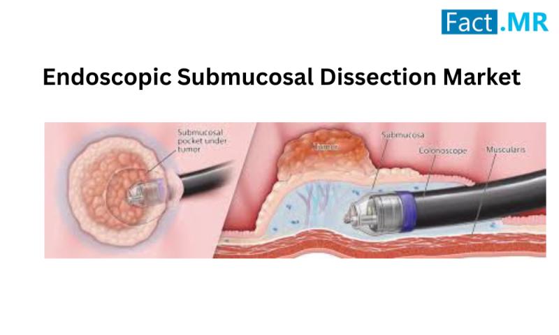 Endoscopic Submucosal Dissection Market is Growing at a CAGR of 7.40% through 2034 | Fact.MR